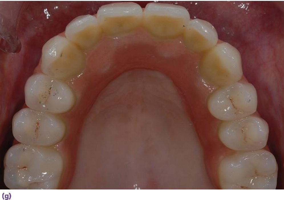 Photo displaying top view of denture inclinical with reduced palatal coverage and buccal flange extension.