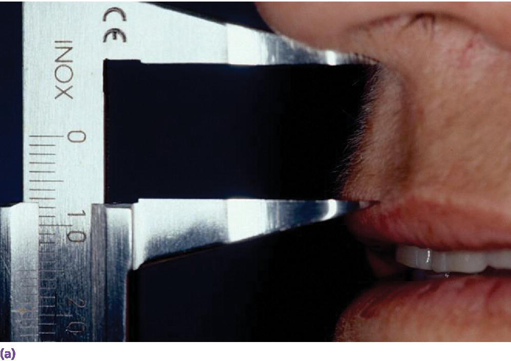 Photo of initial examination in a patient with a short lip line depicted by measuring from subnasal to philtrum with diagnostic set-up in place.