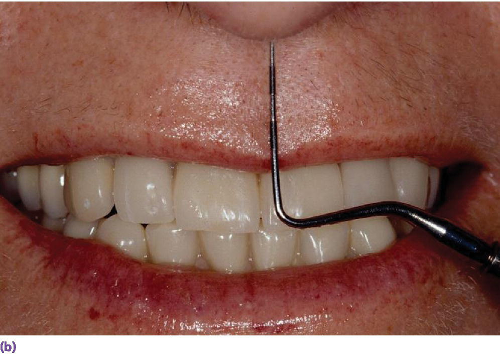 Photo displaying facial teeth with periodontal probe.