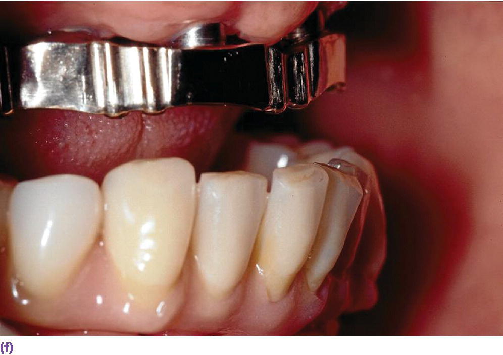 Photo displaying IOD retention with casted gold bar with Bredent Vario soft elements in maxillary part in lateral view.