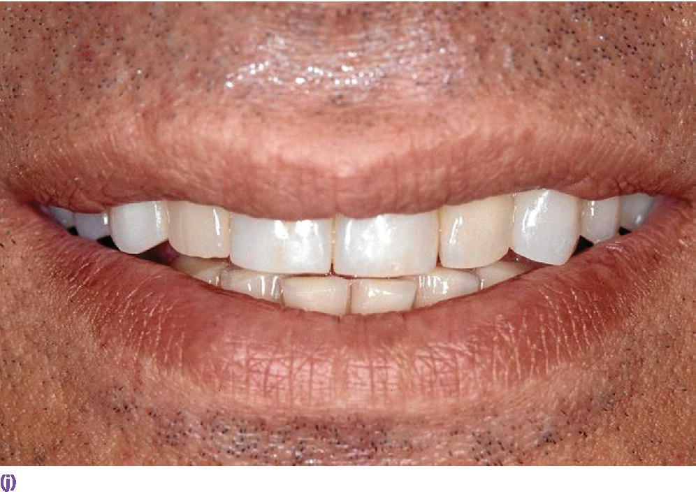 Photo displaying smile line presenting teeth in anterior view.