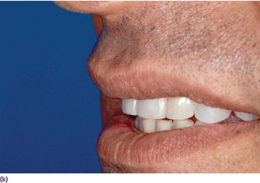 Photo displaying smile line  presenting teeth in side view.
