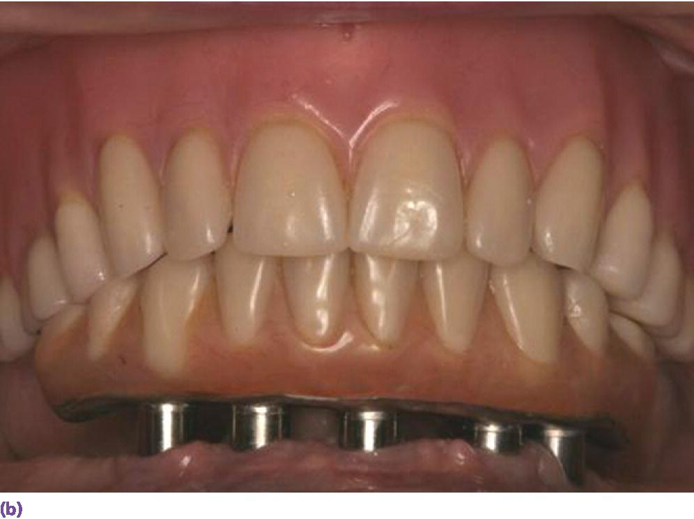 Photo displaying limited cantilever extension for implant fixed complete denture due to minimal AP span generated by vertically placed implants and adhering to formula (cantilever = 1.5AP span).