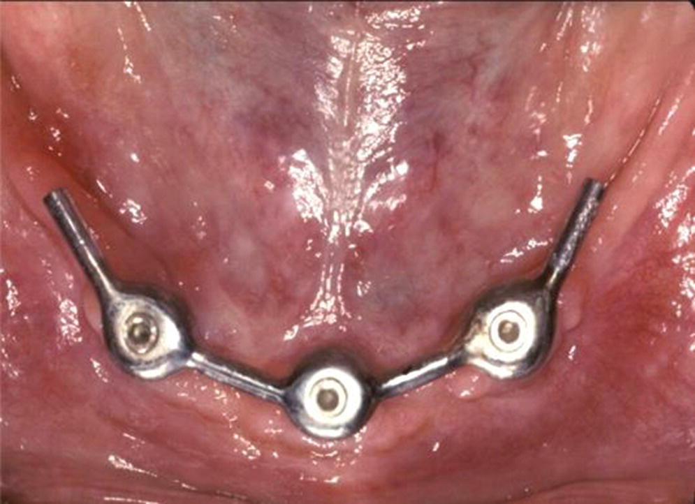 Photo displaying cantilever extension implant overdenture anchorage system designed to improve stability with class II patients.