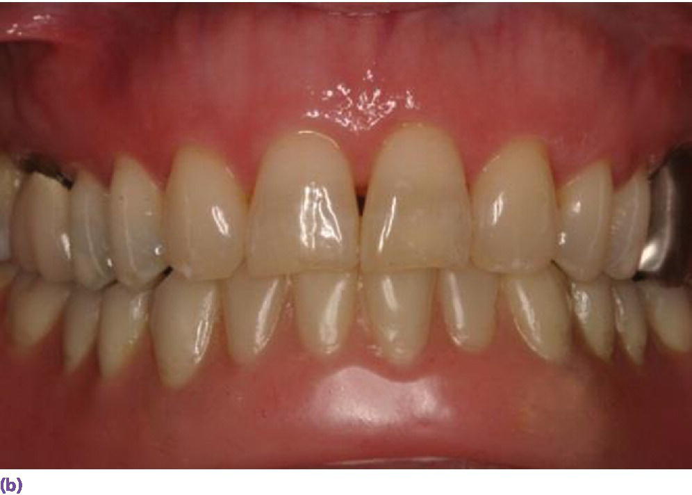 Photo displaying frontal view of mandibular implant overdenture opposing natural dentition.