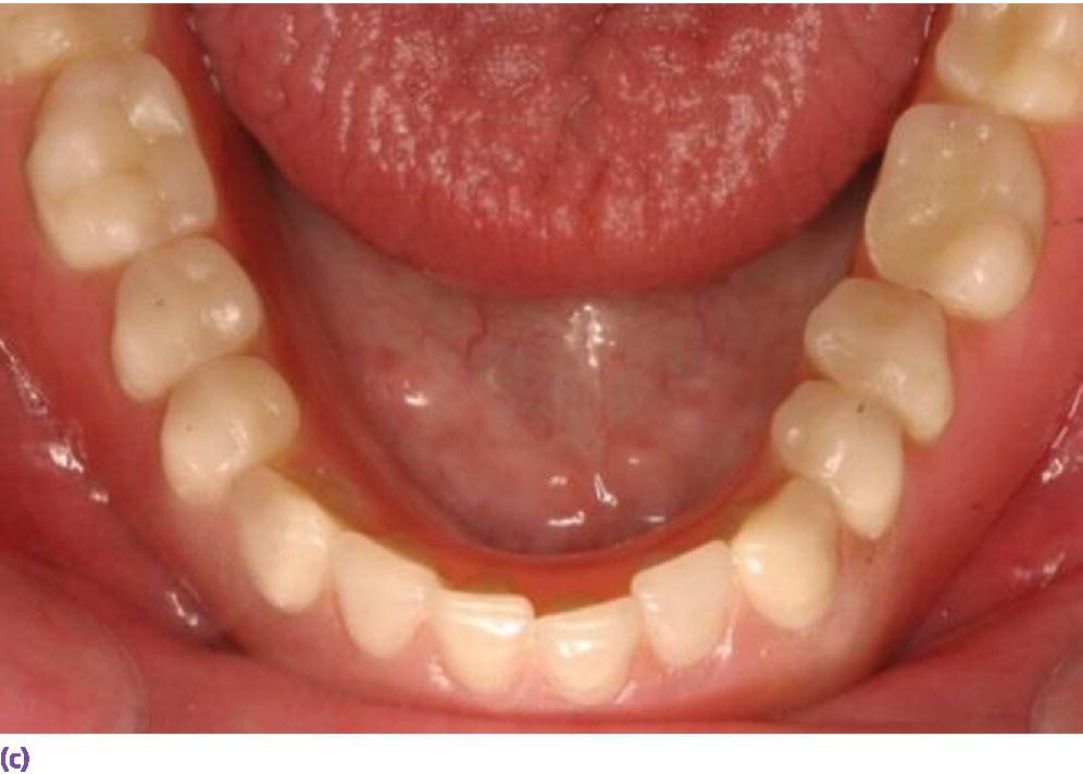 Photo displaying occlusal view of mandibular implant overdenture opposing natural dentition.