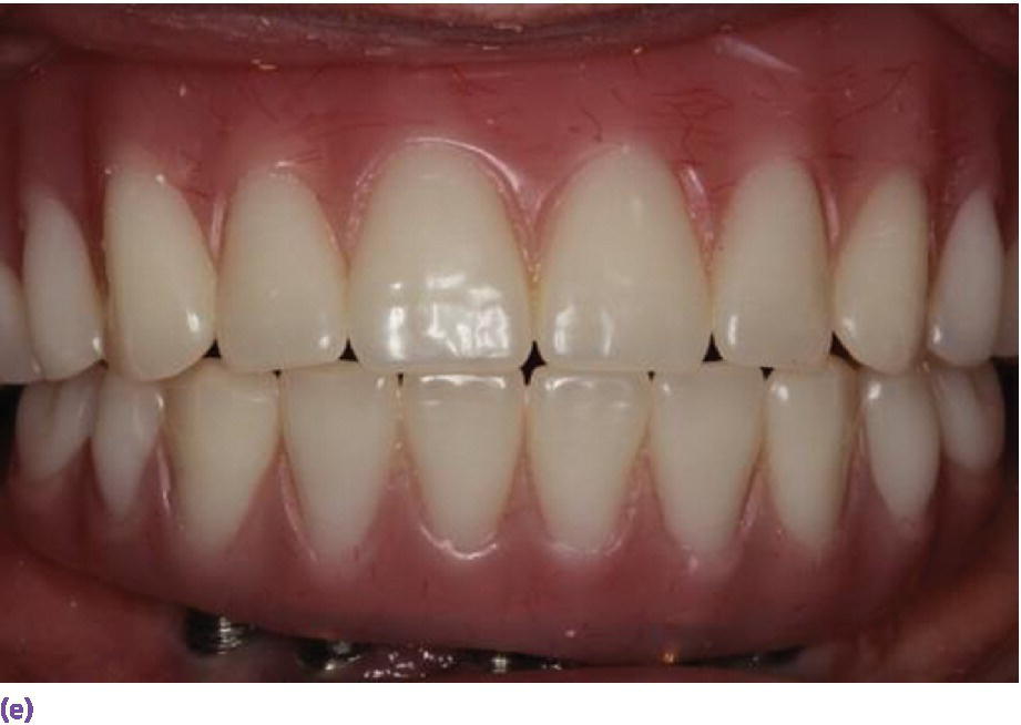 Photo displaying implant fixed complete denture requiring 12 mm of interarch space from crest of soft tissue to opposing dentition.