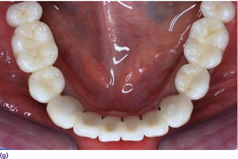 Photo displaying porcelain fused-to-metal implant reconstruction requiring 7 mm of interarch space.