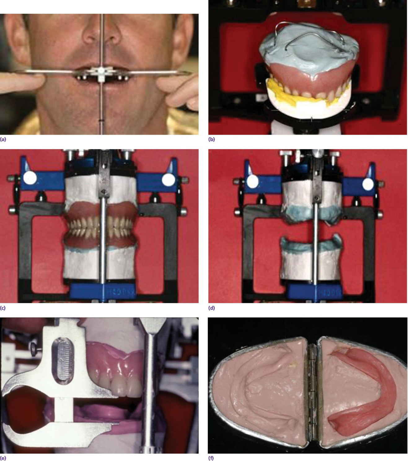 Photo displaying Kois Facial Analyzer in place to transfer, three‐dimensionally, the position of the maxillary denture to the articulator.