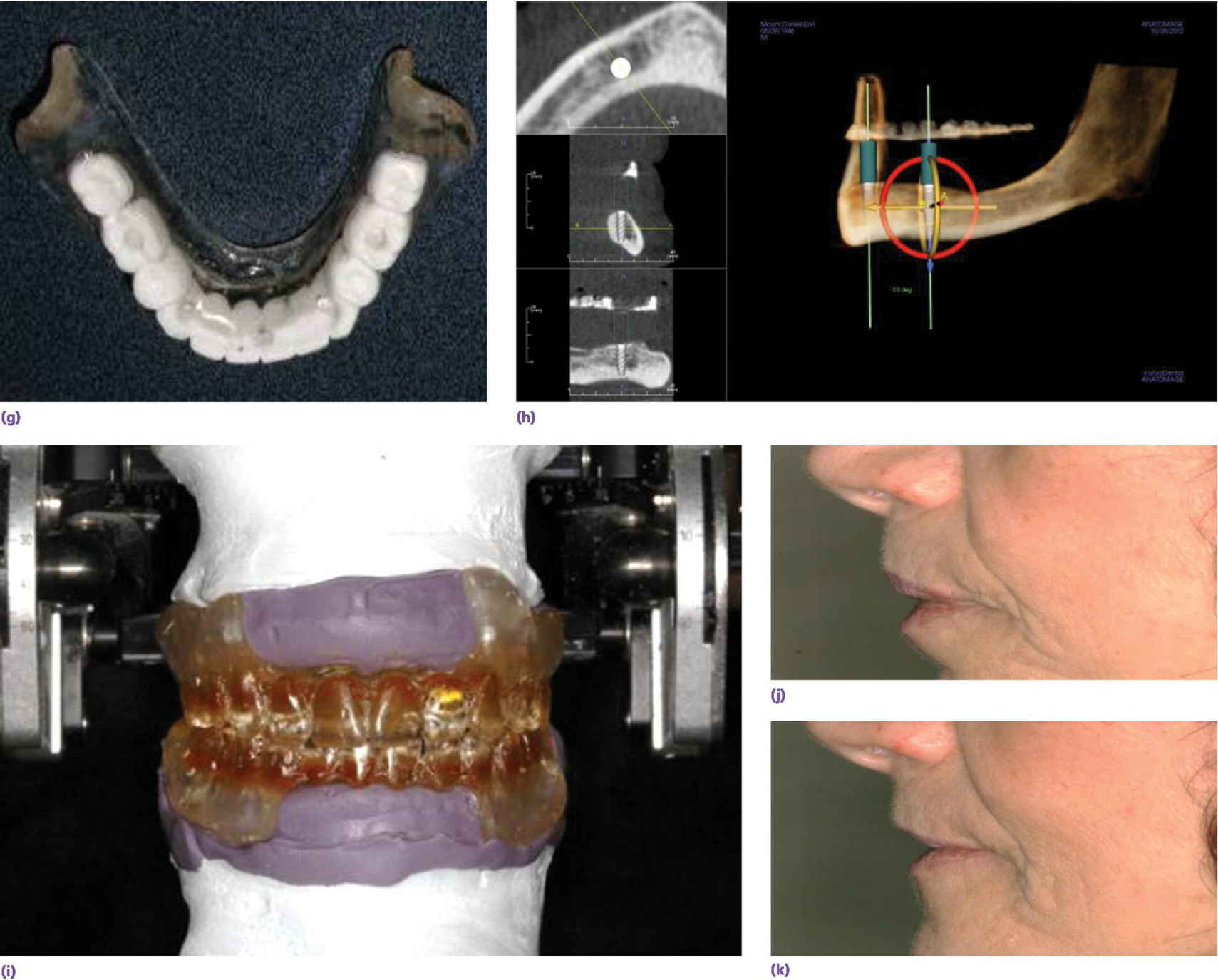 Photo displaying maxillary denture positioned on mounting stand via registration material with intaglio surface is filled with putty and paperclips for mounting stone.