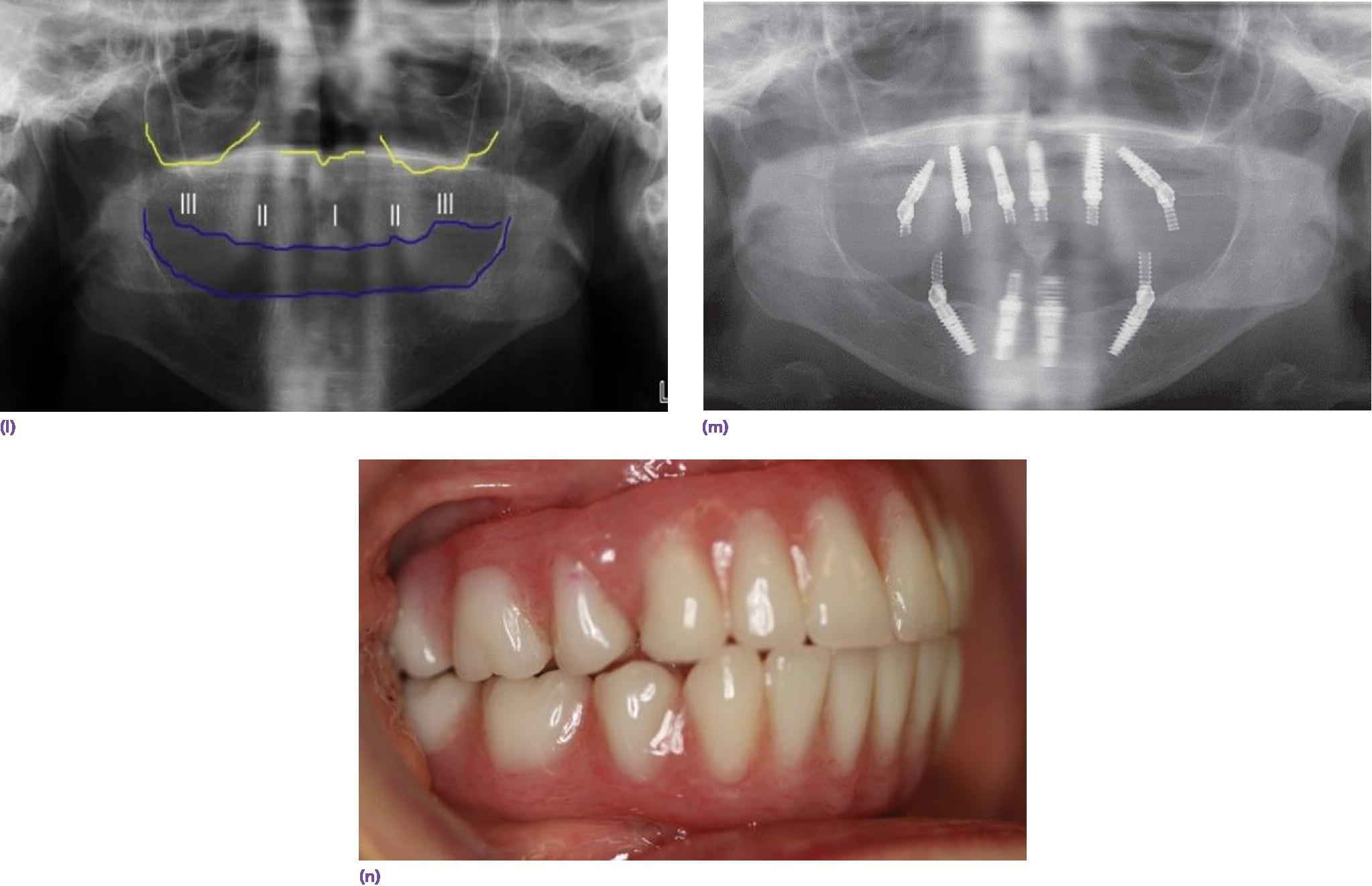 Photo displaying maxillary denture mounted on articular and mandibular denture is hand articulated to it with intaglio surface filled with putti and paperclips for mounting on articulator.