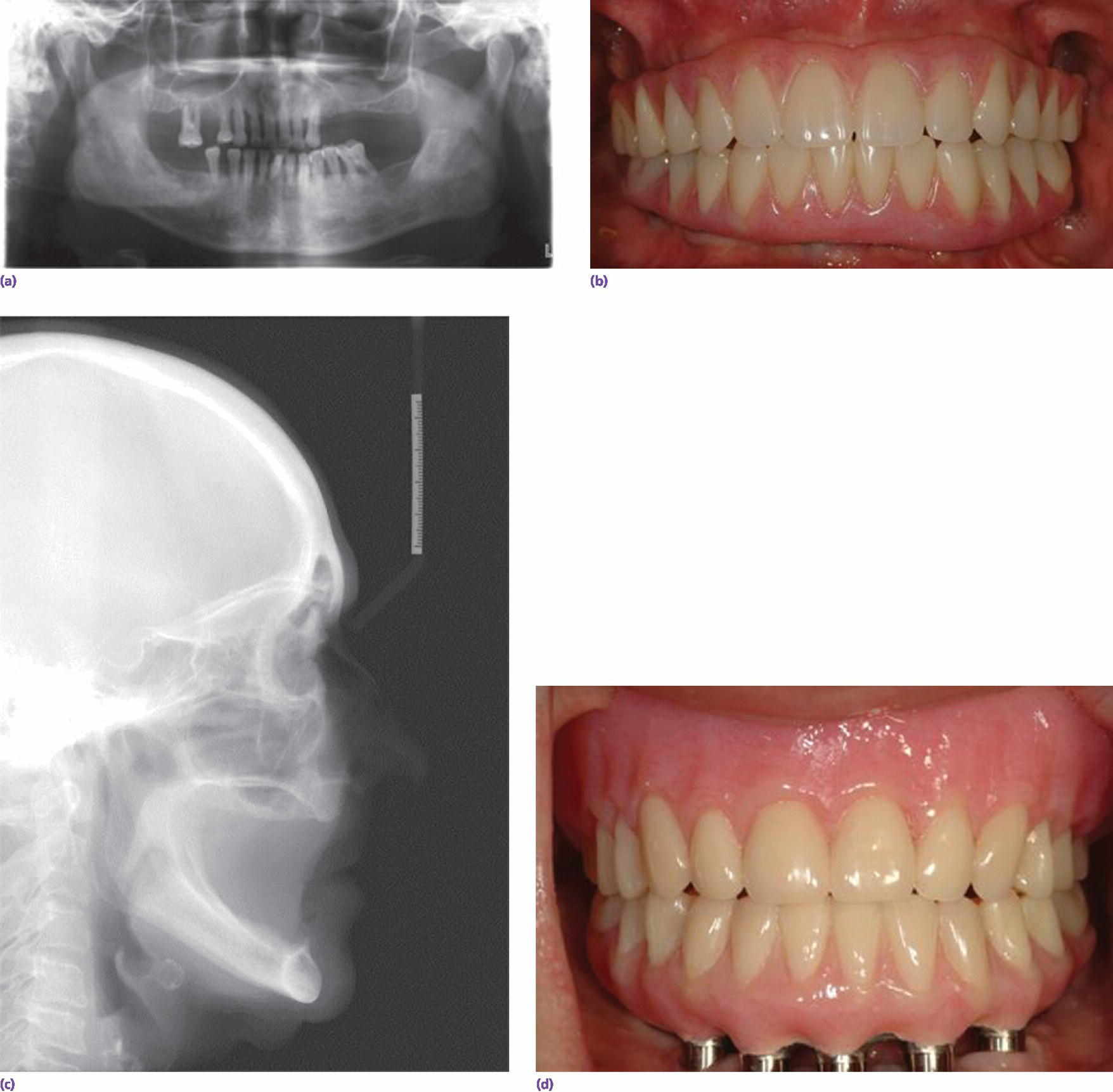 Radiographs of implant prosthetic reconstruction months (top left) and decades after tooth loss (bottom). Photos of implant fixed reconstruction (top right) and mandibular implant fixed reconstruction (bottom).