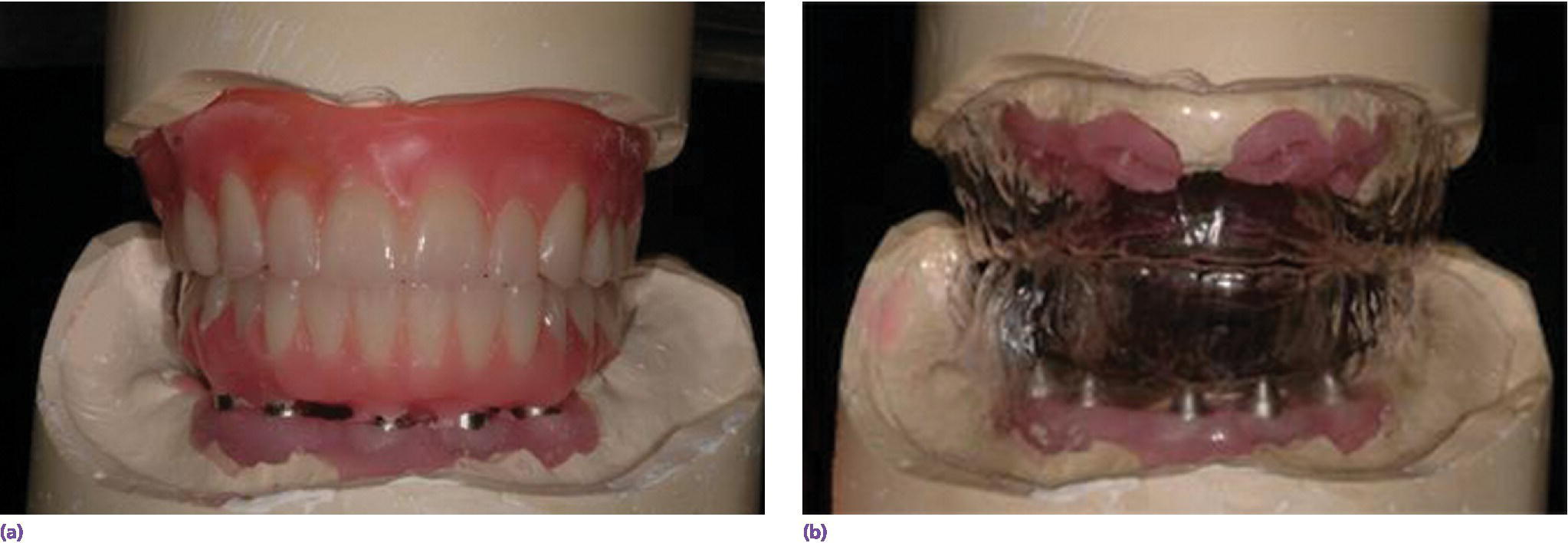 Photos of analog wax-up (top left), and wax-up permits spatial considerations for planning and fabricating maxillary and mandibular prostheses (top right).