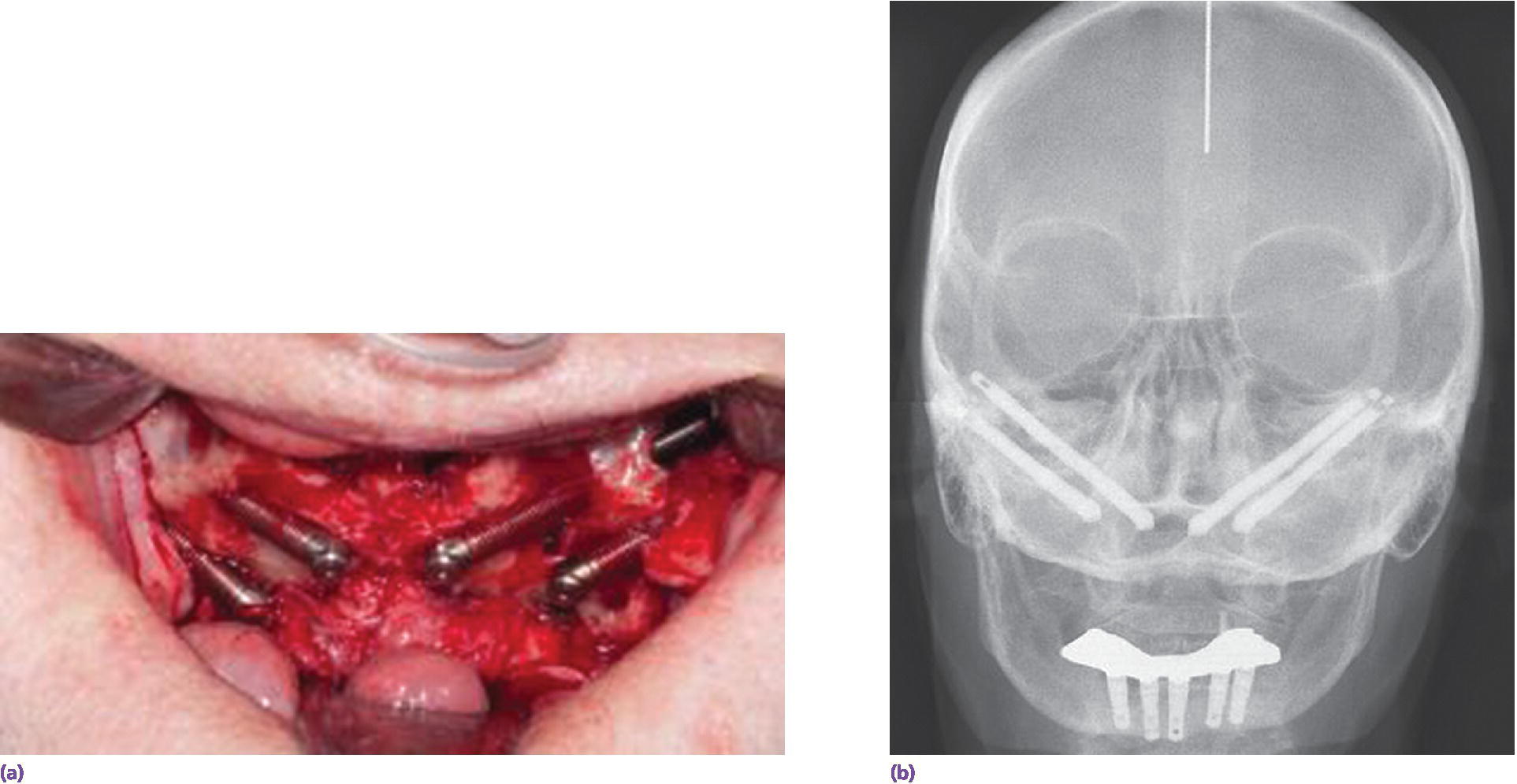 Photo of extended-length zygoma implants placed adjacent to atrophic maxilla (left). Radiograph of clinical view with precision-fit electrical-discharged machined metal-based overdenture (right).