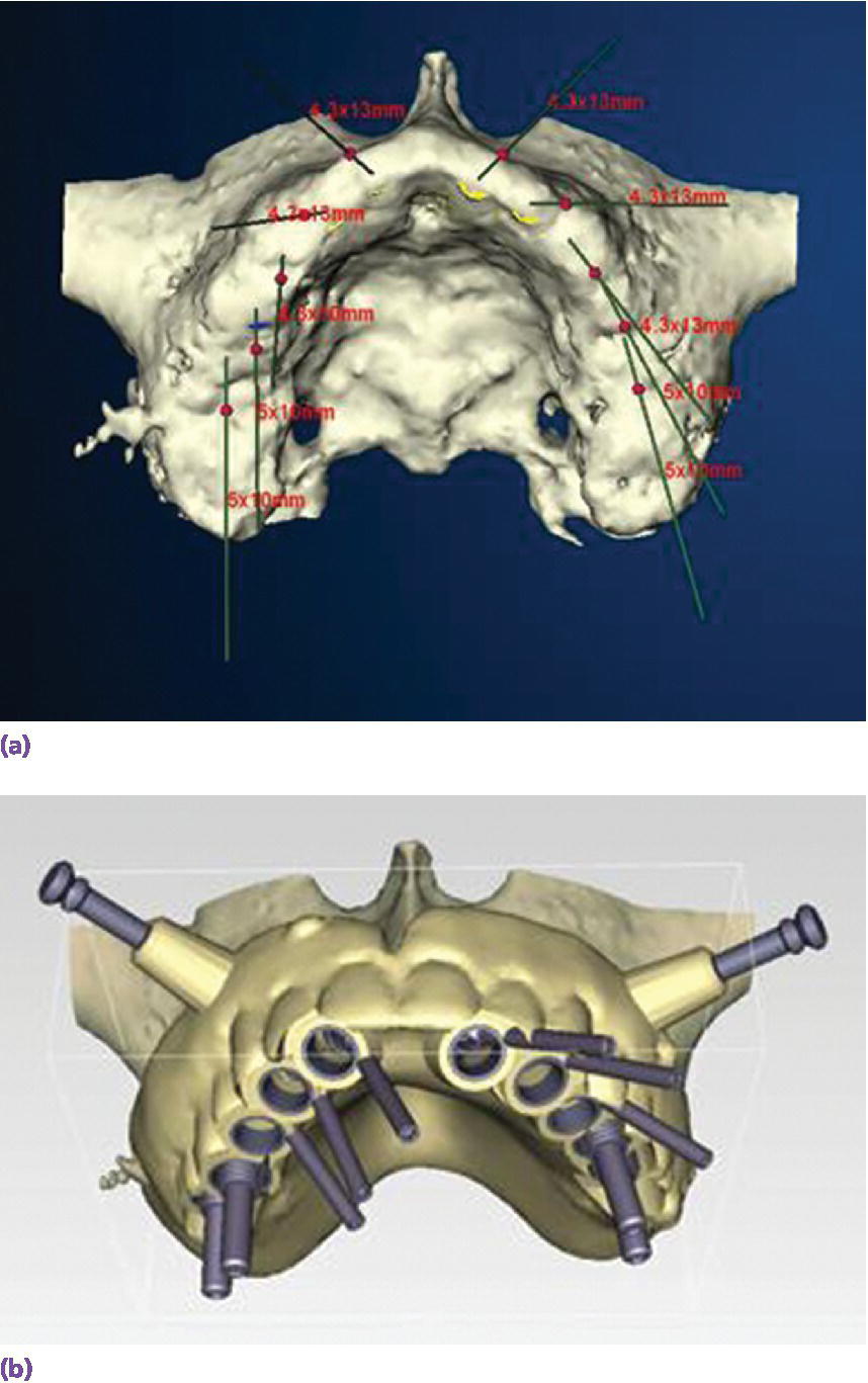 3D displaying patient with alveolar bone with CT scan for site selection and implant angulation for screw‐retained prosthesis(top) and surgical template fabrication supportive of prosthesis design(bottom).