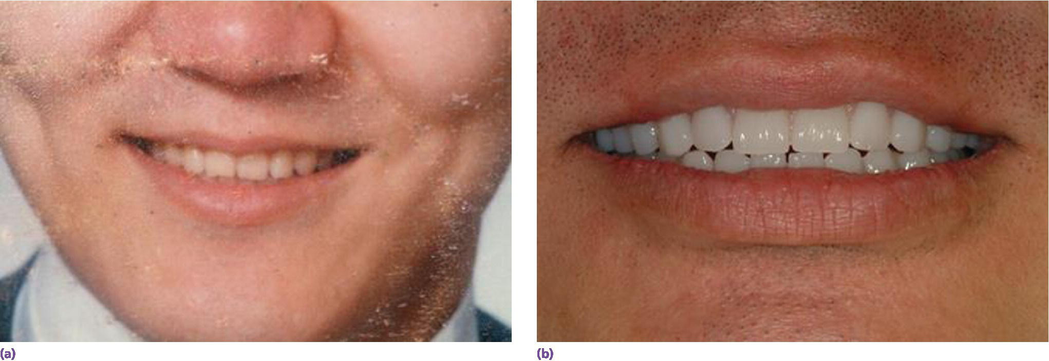 Photos displaying man smiling denoting high school graduation photo of patient with desired esthetics(left) and definitive prostheses with satisfactory lip support and achieved esthetics(right).