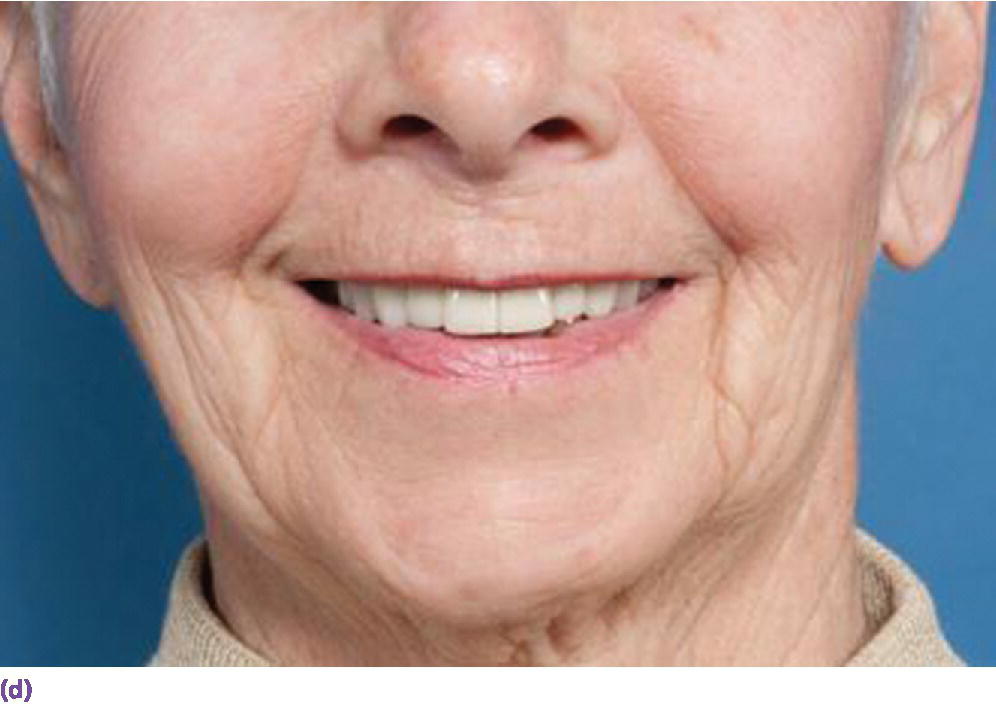 Photo displaying man smiling indicating his anterior view of denture denoting final esthetic result with fixed dental prosthesis.