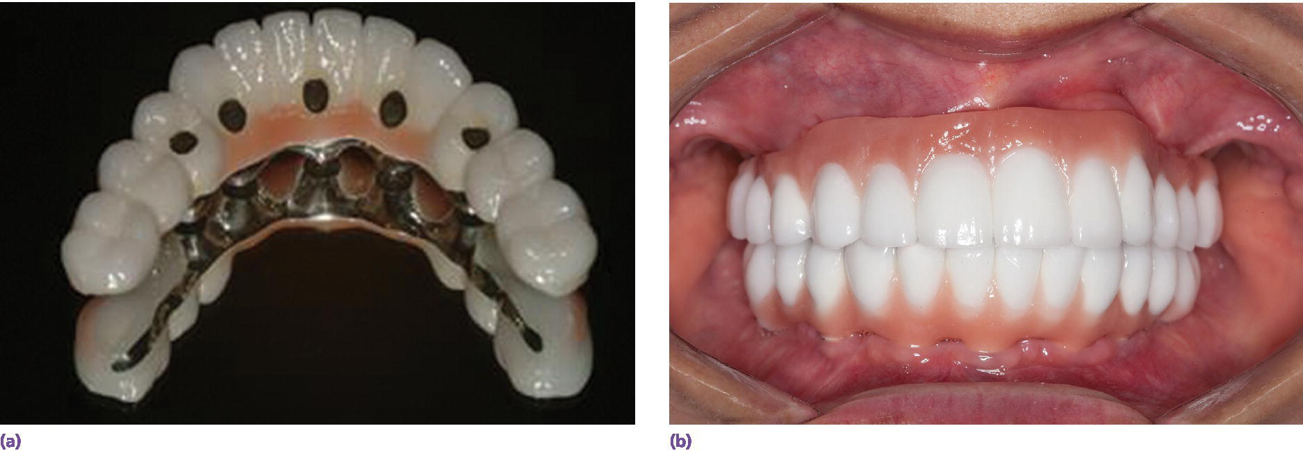 Photos of prosthesis construction with direct-to-fixture connection to secure cantilever design as sole osseous anchorage in interforaminal mandible opposing a maxillary fixed dental prosthesis(left,right).