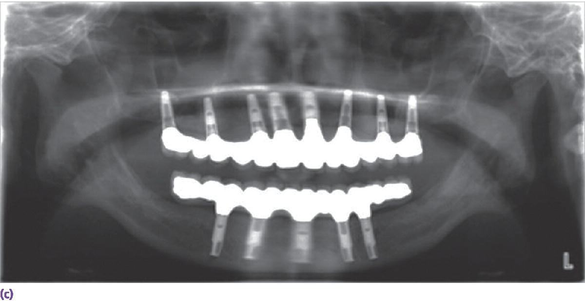 Radiograph displaying palladium–copper framework used to obtain maximal resistance to stress on cantilevered area.