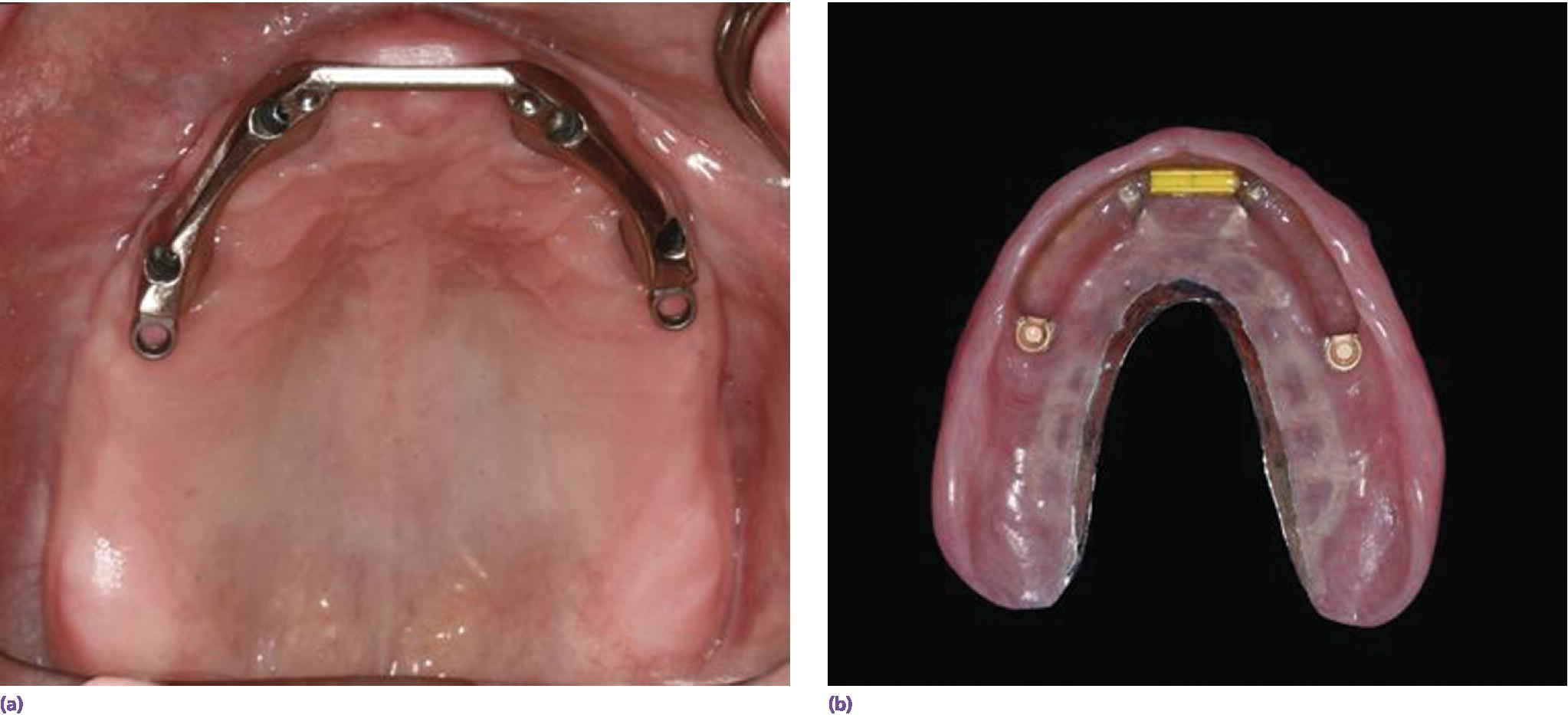 Photos displaying Hader bar attachment in support and retention for (left) metal‐based overdenture design(right).