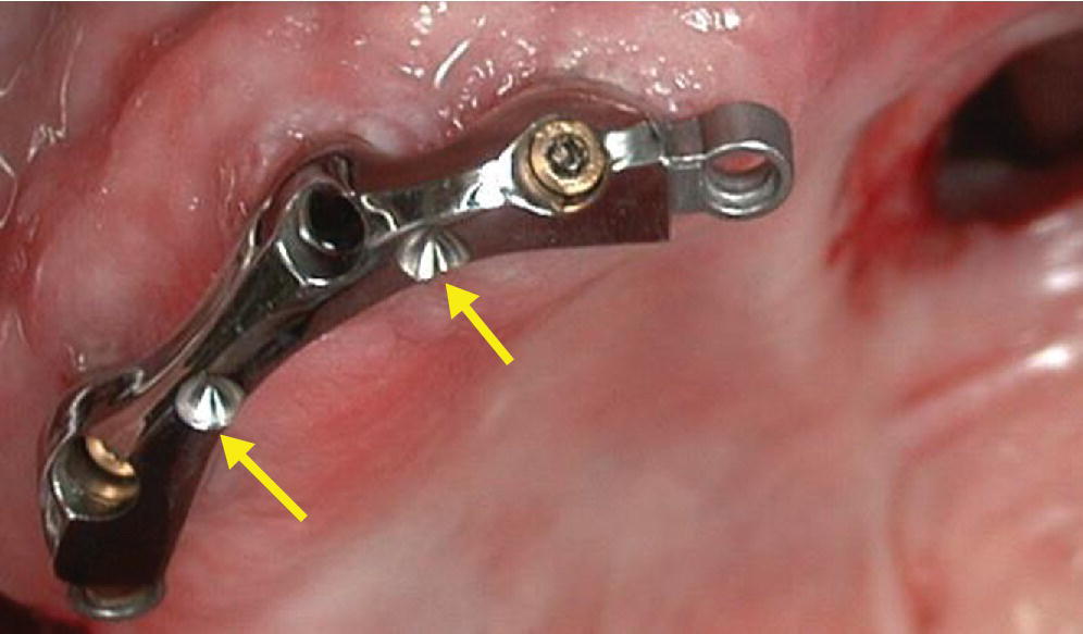 Photo displaying implant connecting bar used to retain a complete denture–obturator in an edentulous maxillectomy patient.
