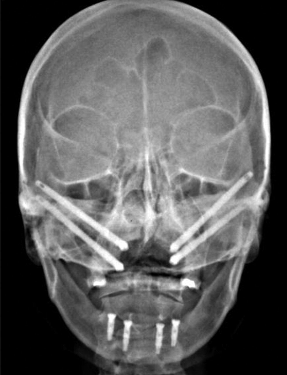 Radiograph displaying two implants placed into each zygoma.