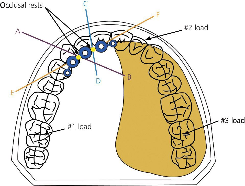 Schematic of ERA attachments attached to each side and occlusal rests placed on top of bar.