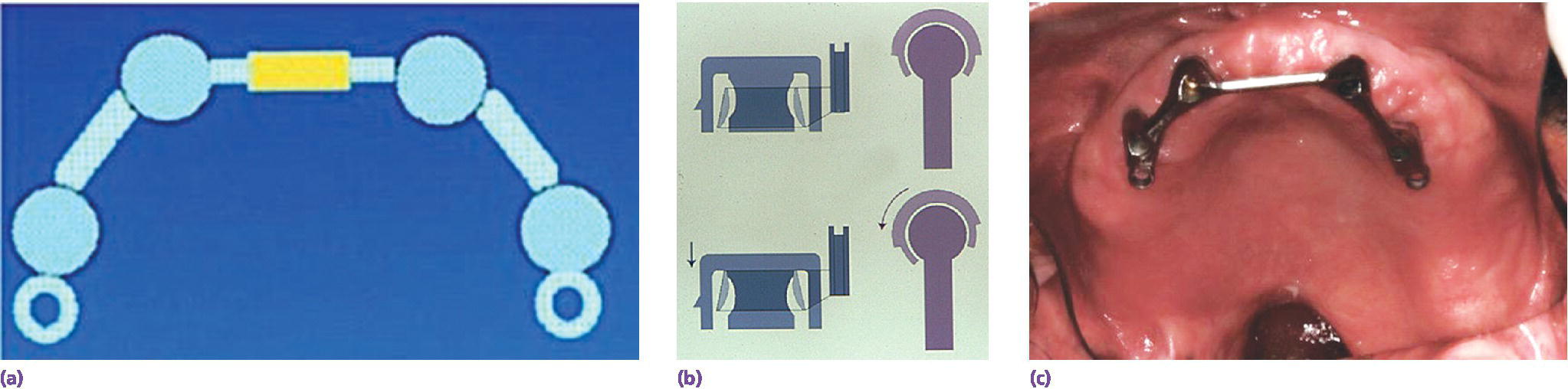 3 photos displaying implants placed into the posterior alveolar ridge.