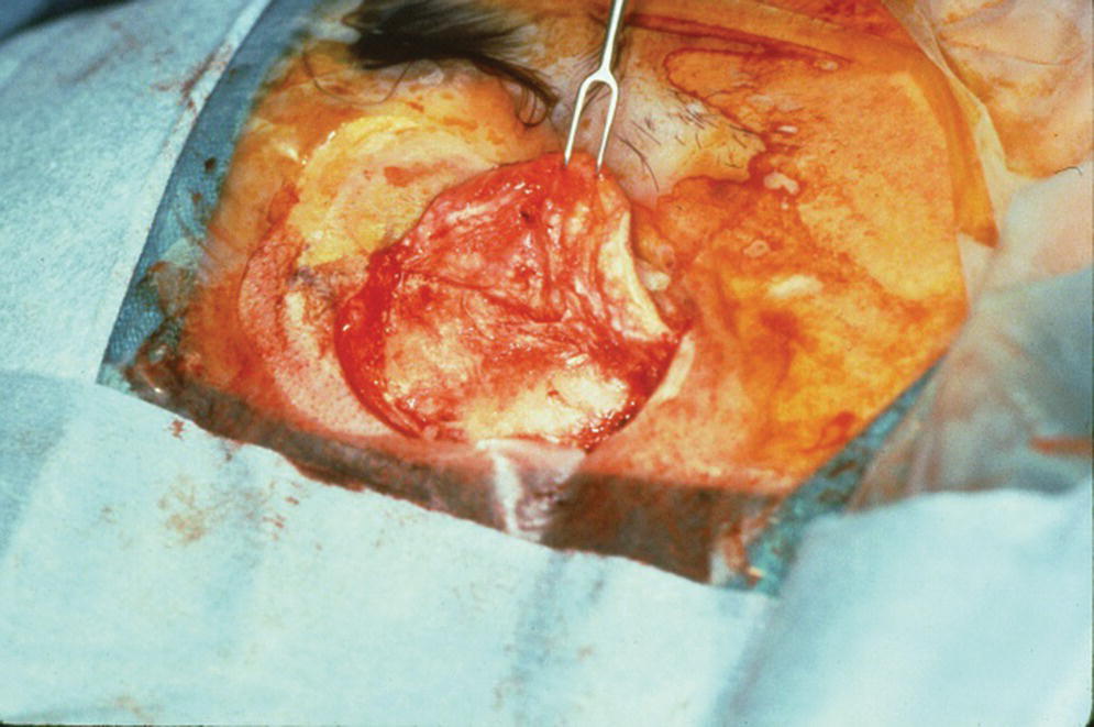 Photo displaying the elevation of full‐thickness flap.