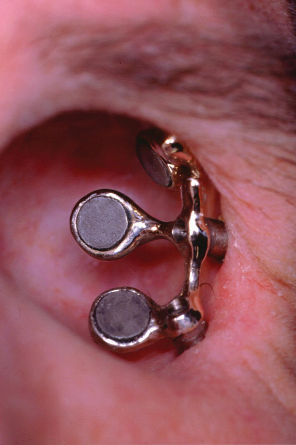 Photo displaying three implants placed in the supraorbital rim and infraorbital rim with a cast bar containing three magnets for retention.