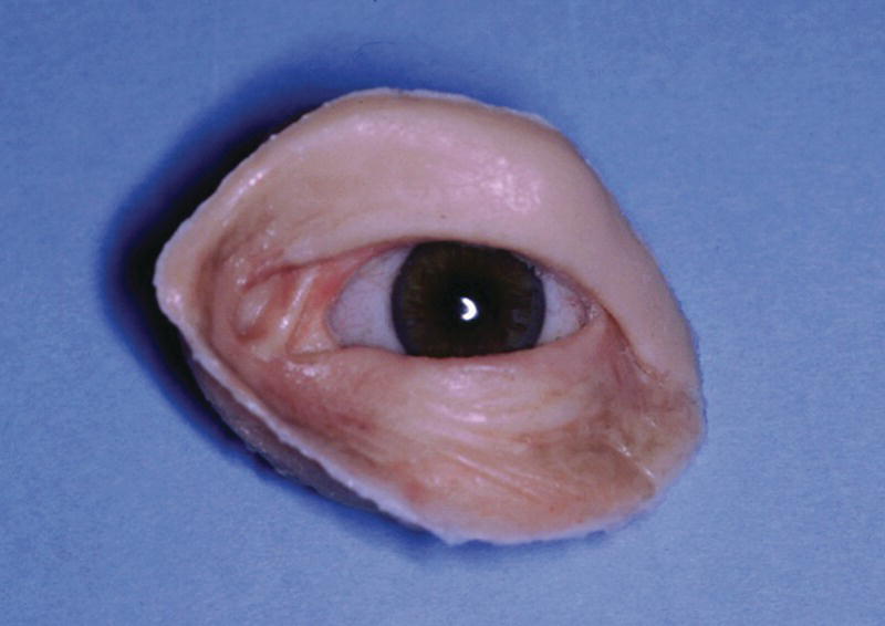 Photo displaying the custom orbital prosthesis which contains a custom ocular prosthesis and the substructure with the magnet keepers.