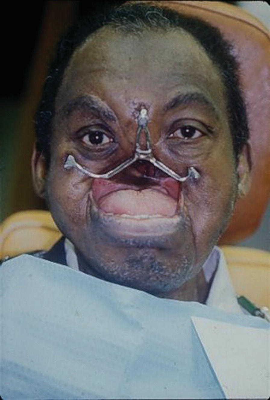 Photo of a man with missing nose and upper jaw wearing a maxillary frame with 3 O-ring attachments.