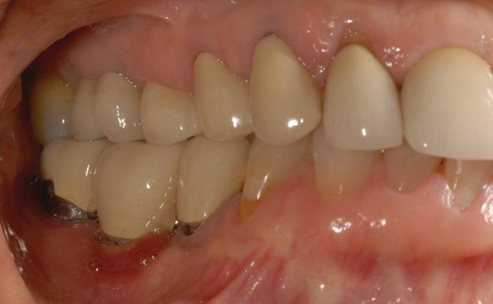 Photo of gum and teeth depicting peri‐implant mucositis in lower right molar.