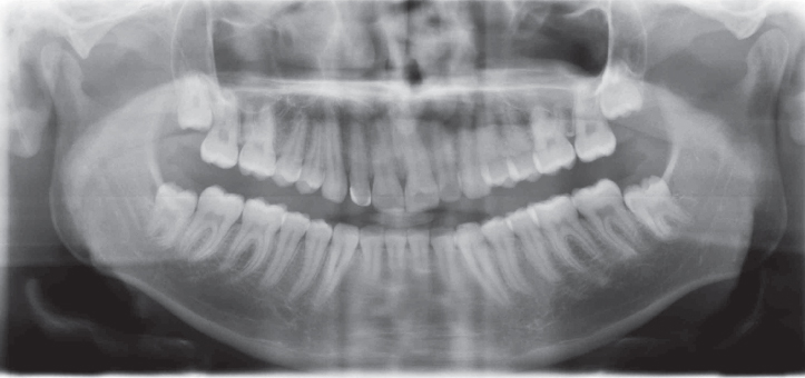 Illustration of Panoramic radiograph showing an absence of gross morphological changes of the TMJ condyles.