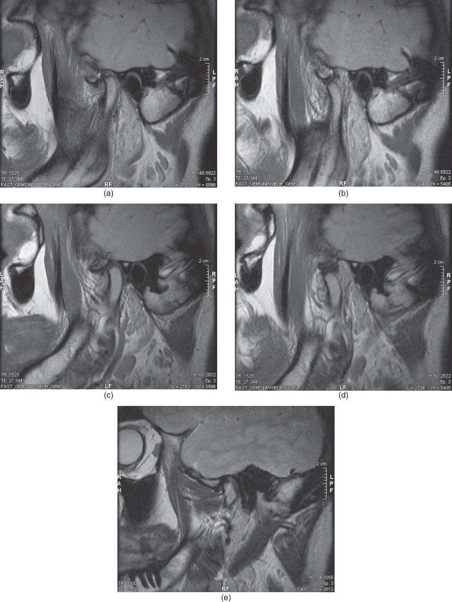 Illustration of MRI showing disc displacement with reduction in the left TMJ (a, b) with absence of TMJ effusion on T2-weighted image (c) and normal disc positions in the right TMJ (d, e).