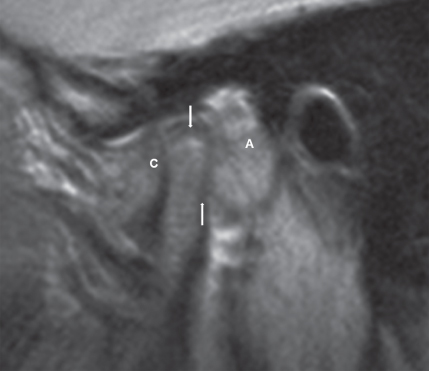 Illustration of Bilateral CBCT of the TMJs showing substantial structural changes in left TMJs with signs of condylar erosions and loss of compact bone on both condyles, bilateral condyle bone loss, condylar flattening, and sclerosis, and bilateral osteophytes.