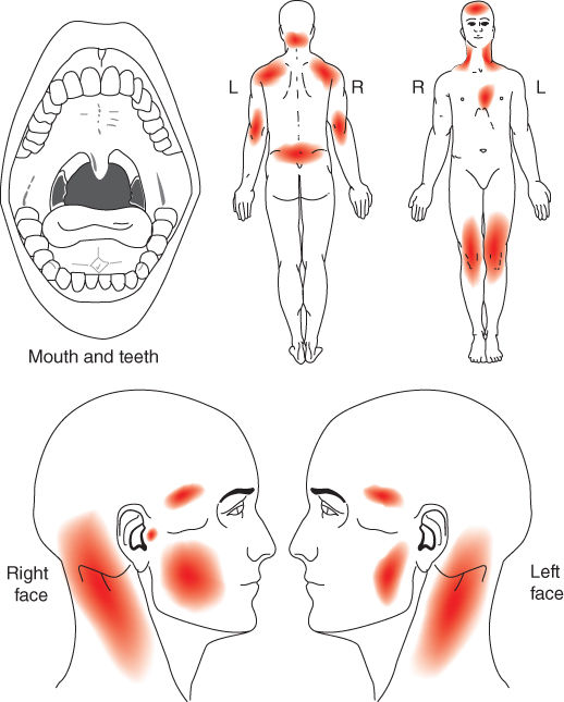 Photo showing Orofacial pain locations confined to masseter muscles.