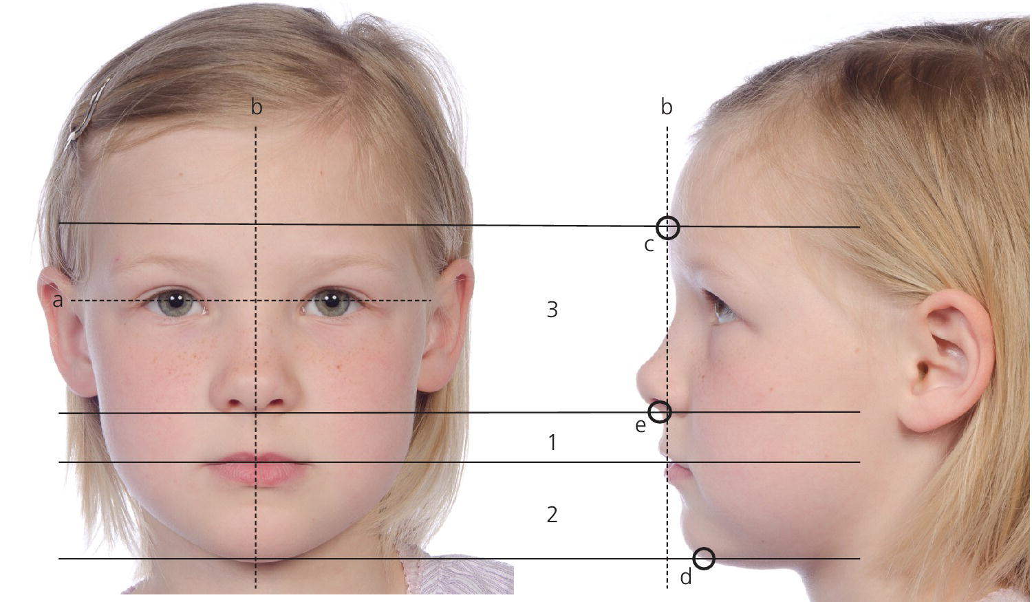 Photos displaying frontal (left) and side views (right) of the same girl with lines drawn labeled a, b, c, d and e at her face depicting assessment of the facial symmetry and proportions.