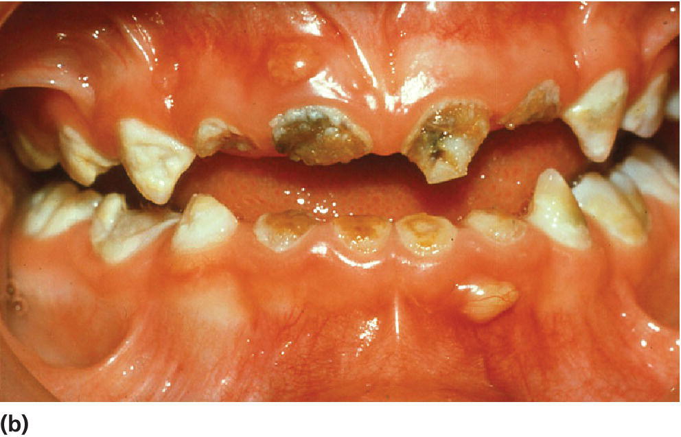 Photo of fistulae and abscesses due to caries in the primary dentition displaying small abscesses in front view of maxillary and mandible.