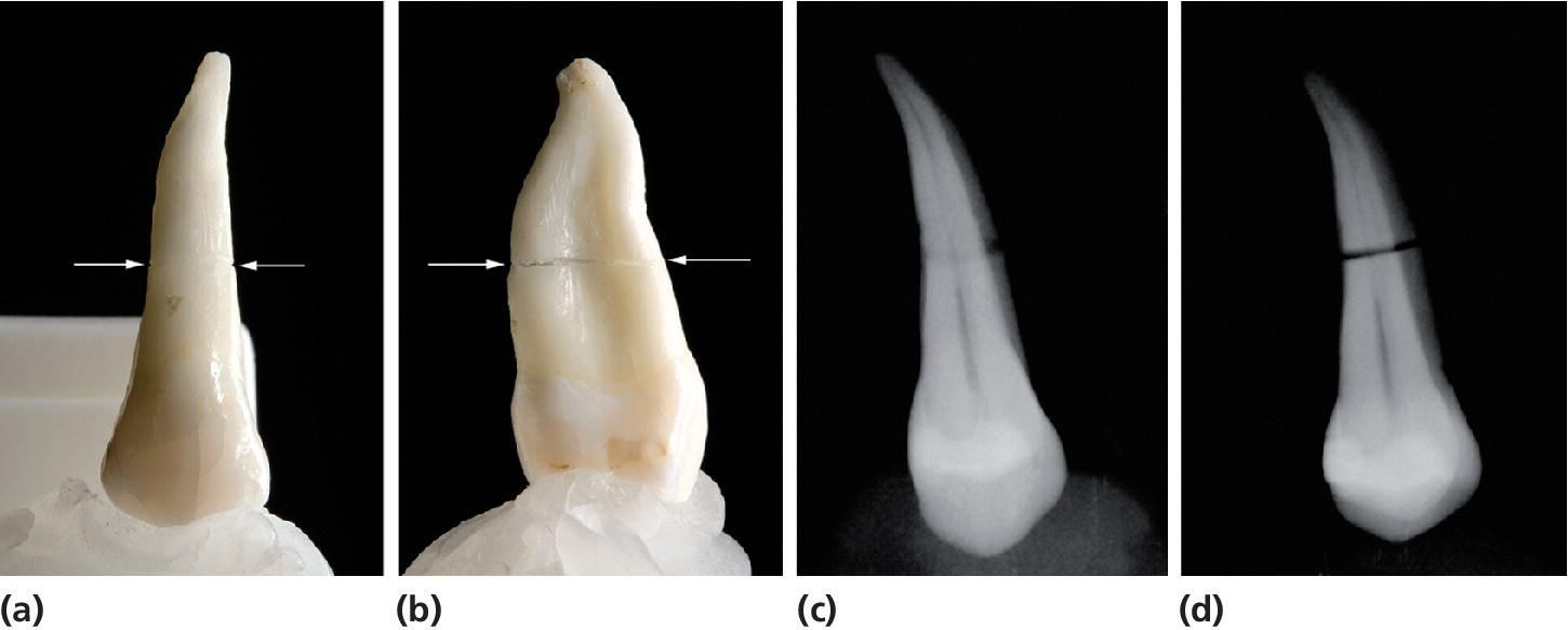 Left: 2 Photos of a tooth with root fracture, displaying the tooth in facial and approximal aspects. Arrows depict direction. Right: 2 Radiographs of the tooth displaying fracture as a circle and as a distinct line.