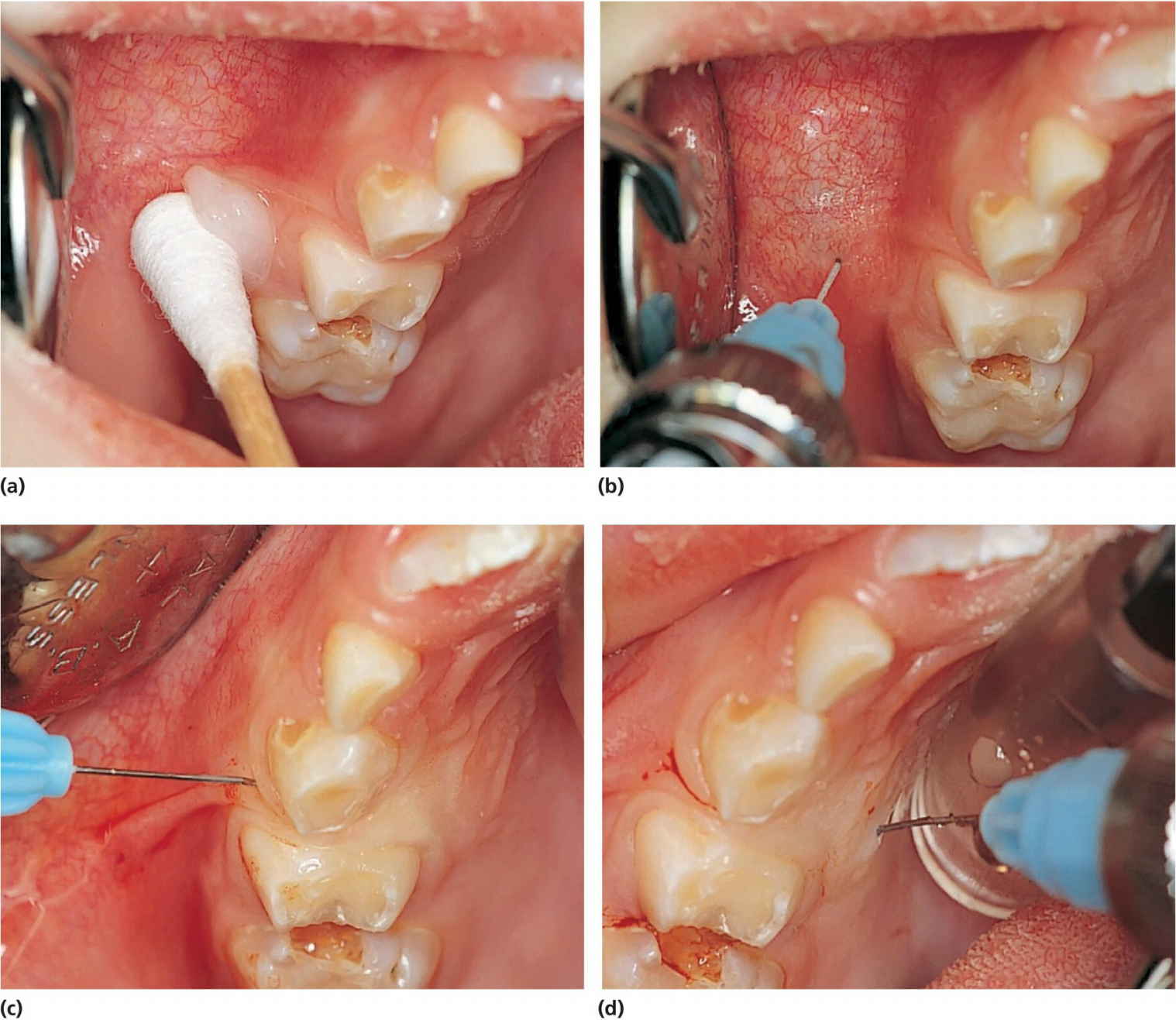 Photos displaying a cotton bud with ointment at the injection spot (a), infiltration analgesia followed by a transpapillary injection starting from the buccal and continuing to the palatal mucosa (b–d).