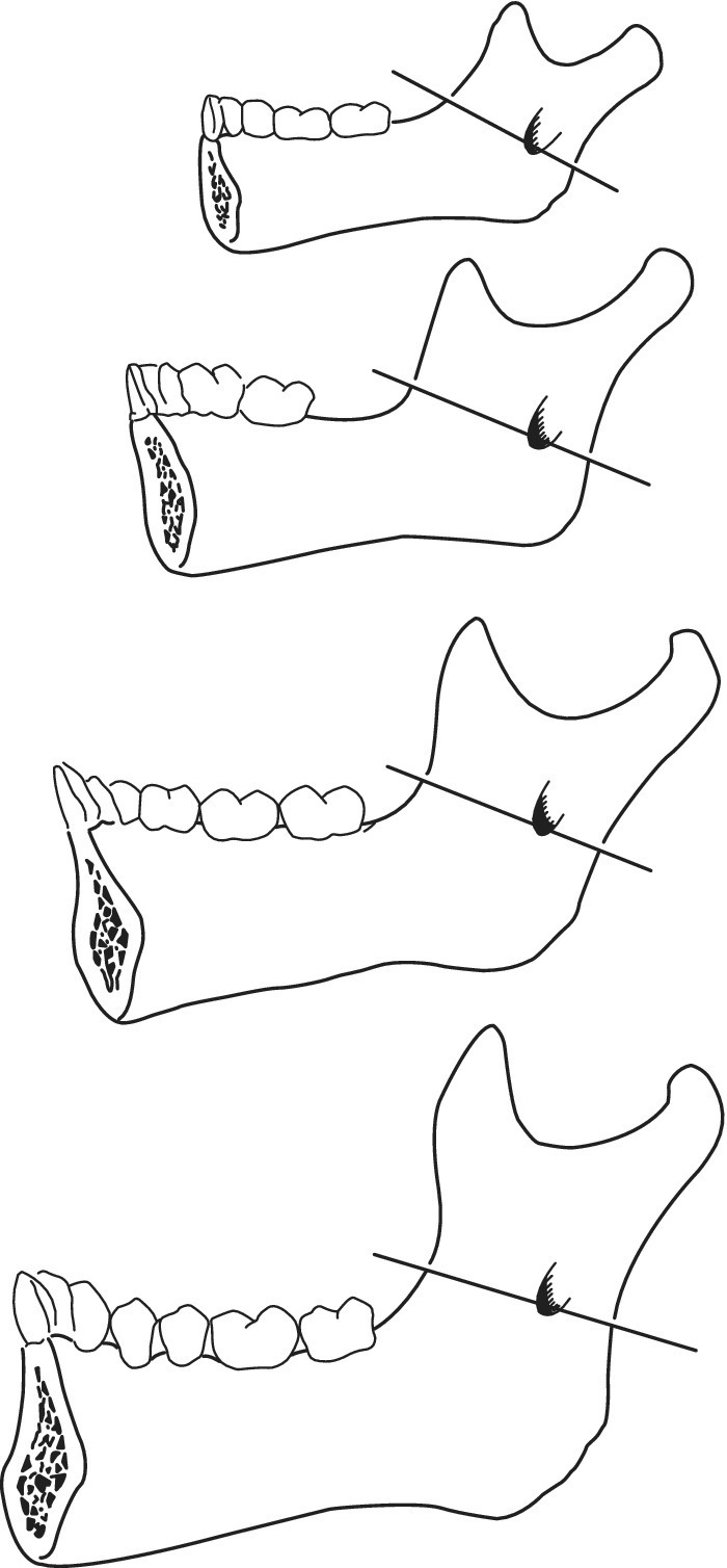 Line drawings depicting the change of position of the mandibular foramen during growth, with foramen always situated on the line.