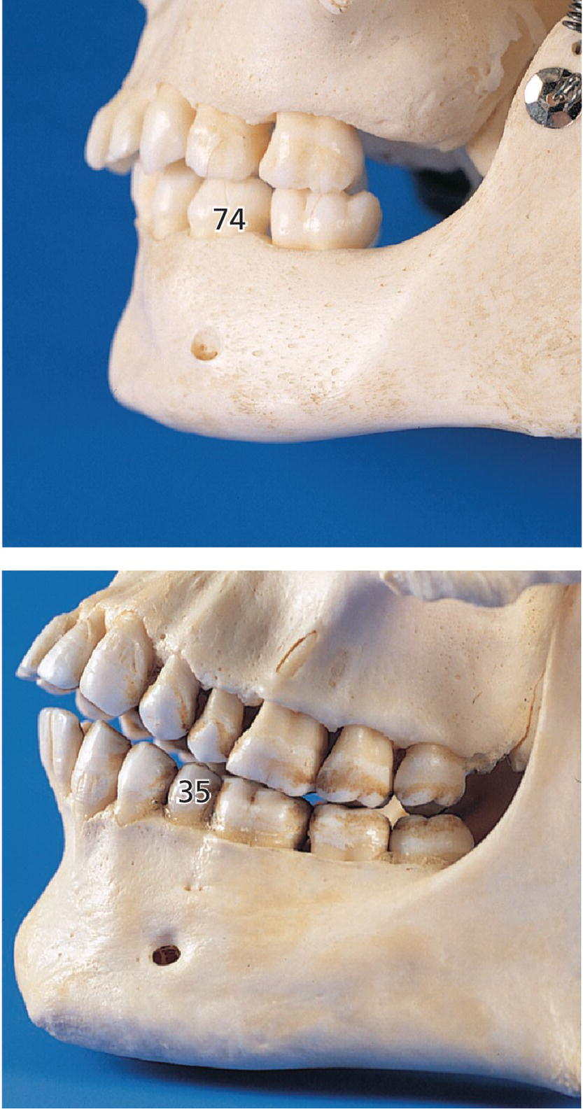 Two photos of skulls displaying mental foramen located closer to the primary mandibular first molar (top) and the permanent second premolar (bottom).