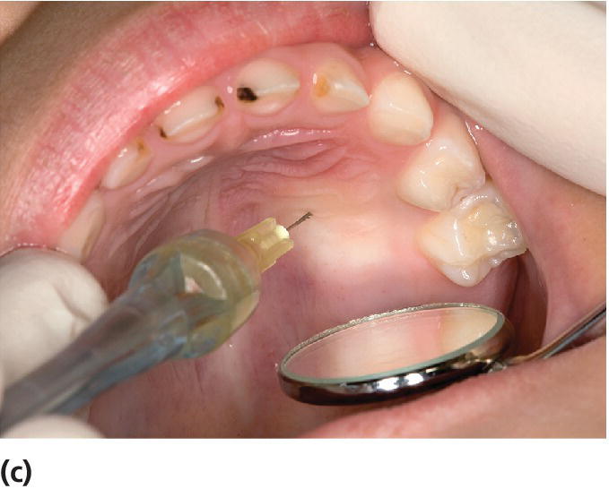 Photo displaying a 30-gauge extra-short needle oriented midway between the free gingival margin and the palatine suture.