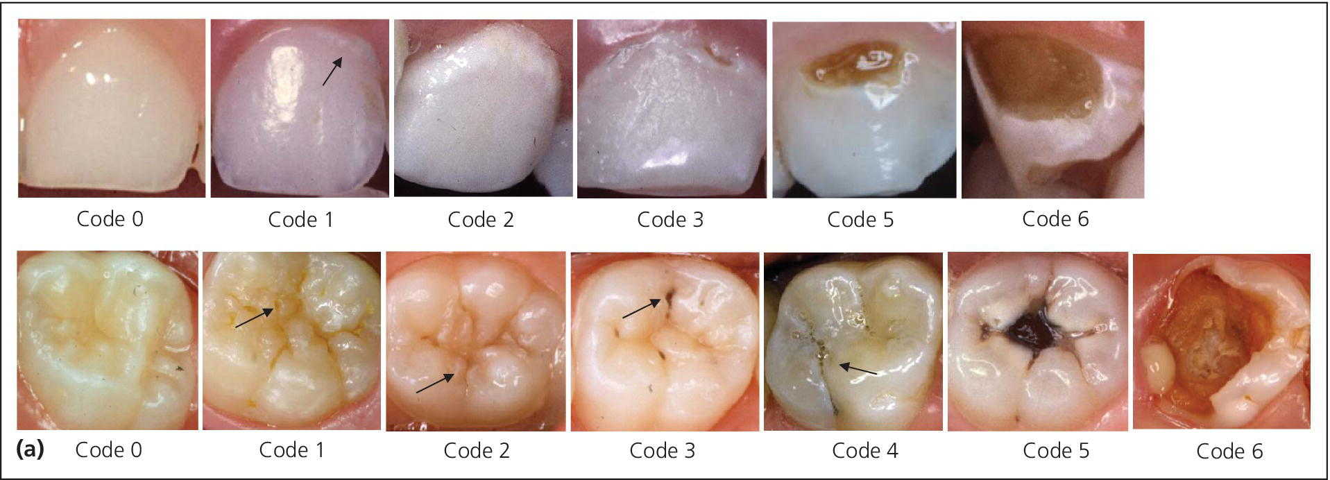 Two sets of photos of the teeth, depicting the ICDAS-based criteria for severity grading of caries on free smooth and occlusal tooth surfaces.