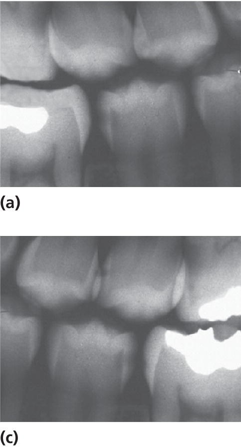 Radiographs of the two mandibular second premolars, displaying radiolucency in the outer dentin.