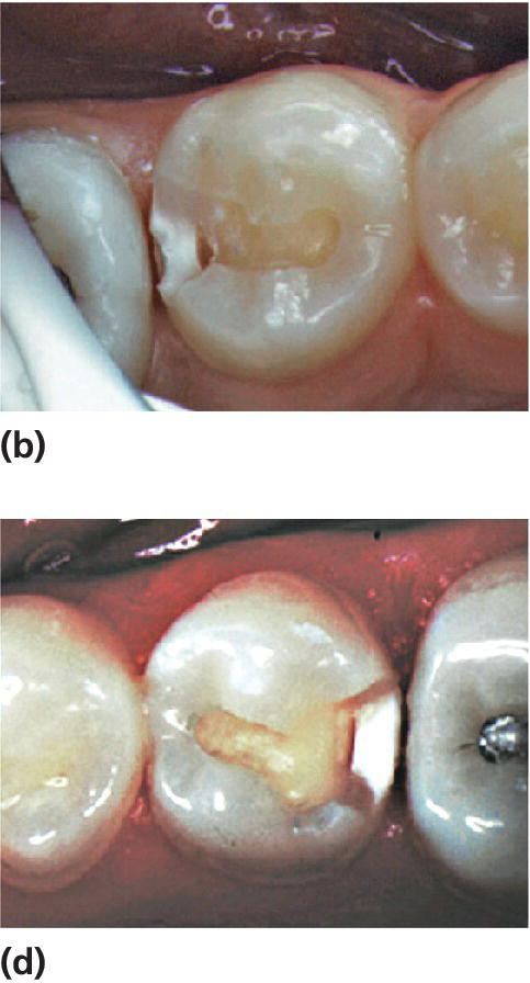 Photos displaying caries lesions on distal surfaces of two mandibular second premolar.