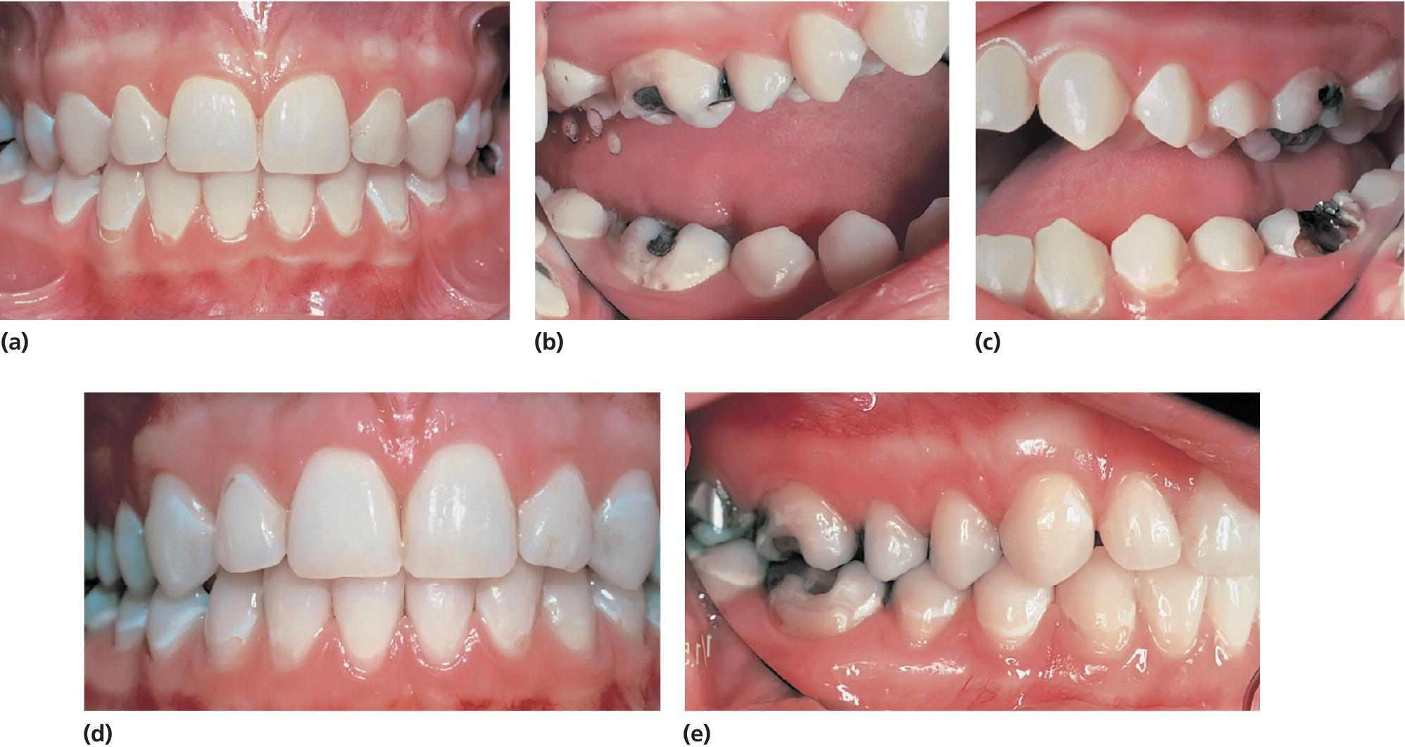 Photos displaying teeth of a 13-year-old girl, with active caries (a–c), same teeth with adequate caries control, 5 years later (d), and same teeth still with adequate caries control, another 3 years later (e).