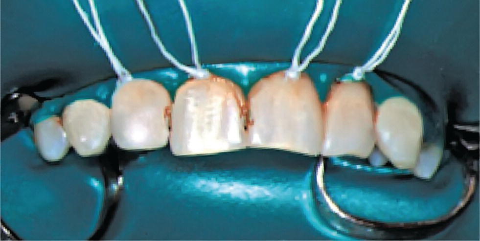 Photo displaying rubber dam used for isolating and drying the operation field before restorative therapy of maxillary incisors.