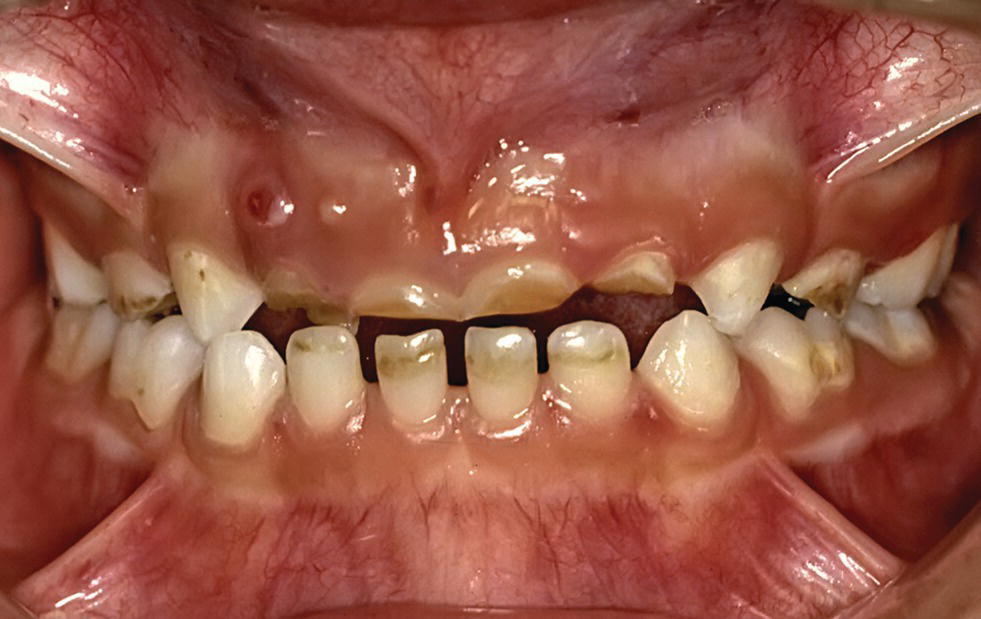 Photo of dental erosion in a 6-year-old child as a result of lemon sucking. Severe endodontic problem especially in regio 52 and 51 is displayed.